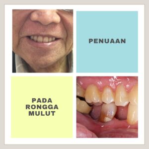 dokter gigi antapani - Penuaan Pada Rongga Mulut