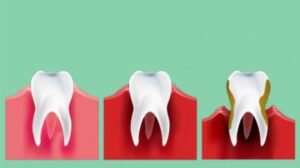 Apa itu Periodontitis?